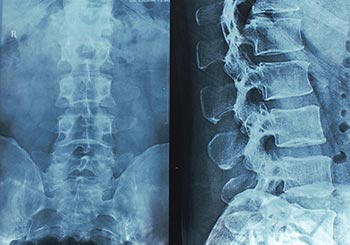 These are spinal X-rays to illustrate our post on spine surgery research.