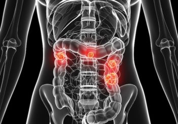 This is an illustration of a colon with cancer, depicted in an artistic, glowing style.