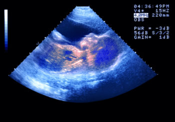 An ultrasound of a baby in the womb.