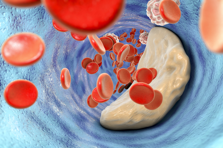 An illustration of atherosclerotic plaque