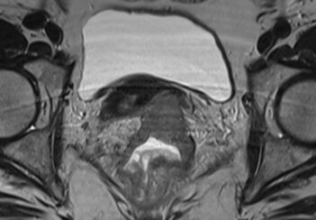 Rectal cancer MRI