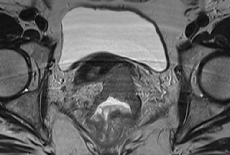 Imaging Can Let Rectal Cancer Patients Avoid Surgery